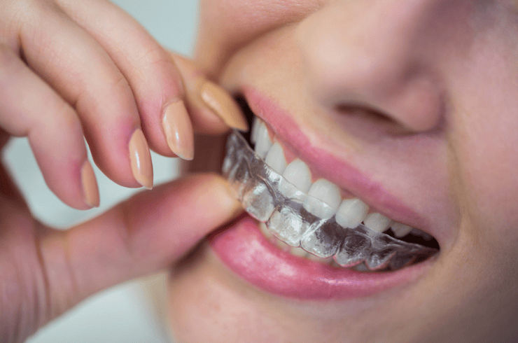 Invisalign (Clear Aligners)