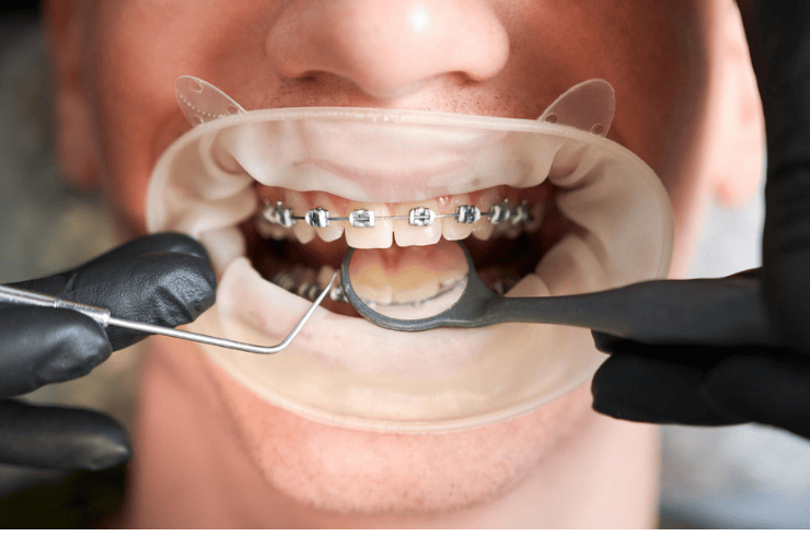 Orthodontic Appliances